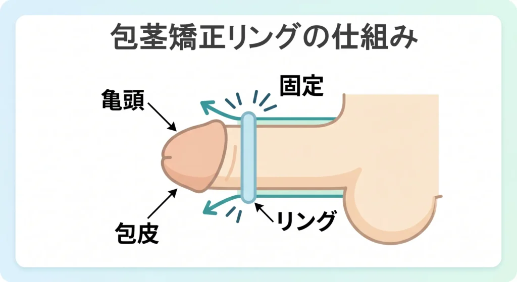包茎矯正リングの仕組みと目的